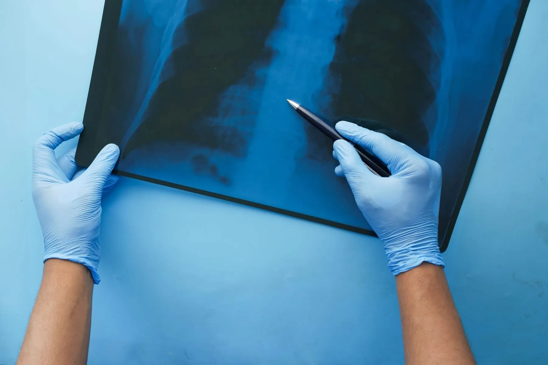 Gloved hands holding a chest X-ray against a blue background
